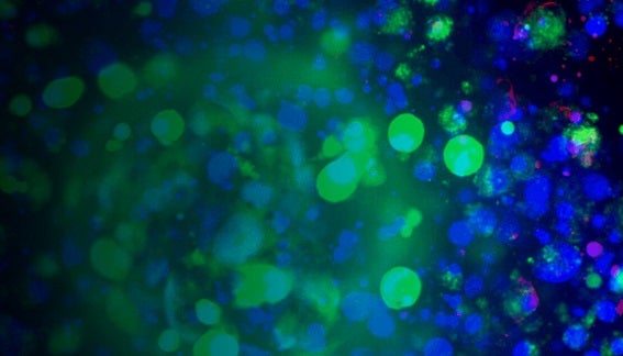 3D triple-negative breast cancer