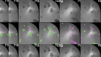 Organoids and AI are helping in Cancer