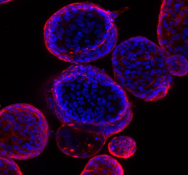 Duodenal adenoma organoids derived from biopsy tissue from a FAP patient